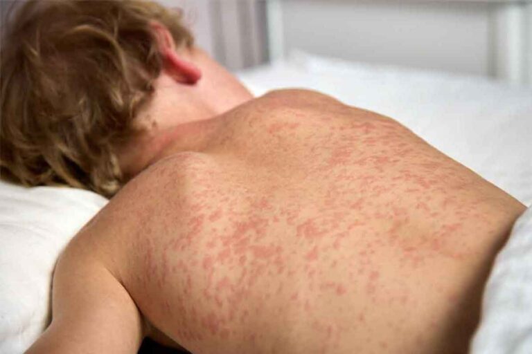 Measles diagnoses on Manitoulin