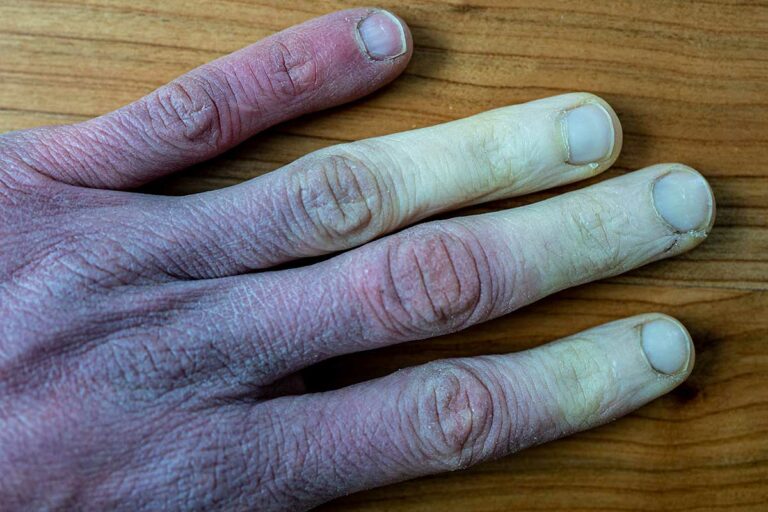 Public Health shares tips on preventing frostbite and hypothermia